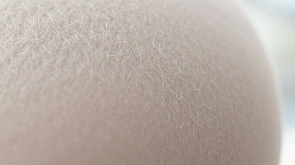 Jakie są przyczyny łysienia androgenowego związane z testosteronem?